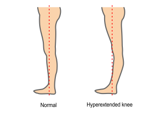 Hyperextension Knee Brace  Hyperextended Knee Prevention & Treatment
