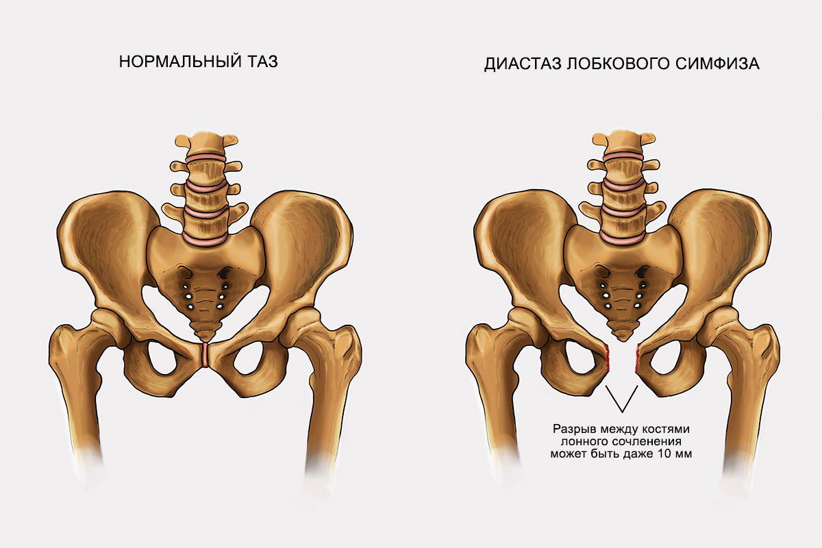 Расширение таза. Симфизит тазобедренного сустава. Лобковый симфиз анатомия. Симфизит лобковой кости.