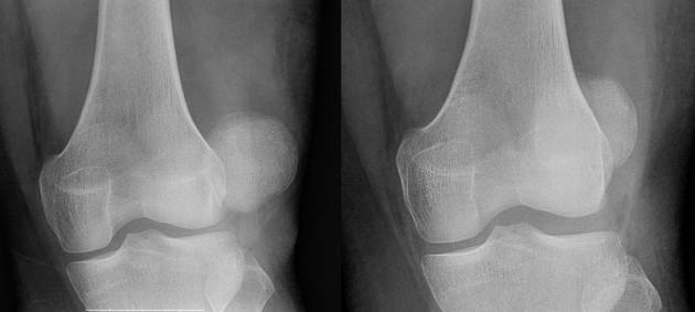 Patella dislocation / subluxation