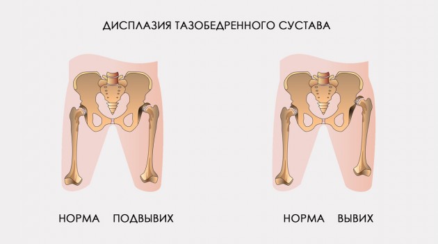 ДВУХСТОРОННИЙ ОРТЕЗ БЕДРЕННОГО СУСТАВА С РЕГУЛИРОВКОЙ ПОДВИЖНОСТИ СУСТАВОВ И РЕГУЛИРОВКОЙ ДЛИНЫ ШИН AM-SB/1RE DUAL