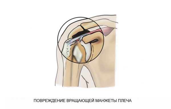 Повреждение вращающей манжеты плеча